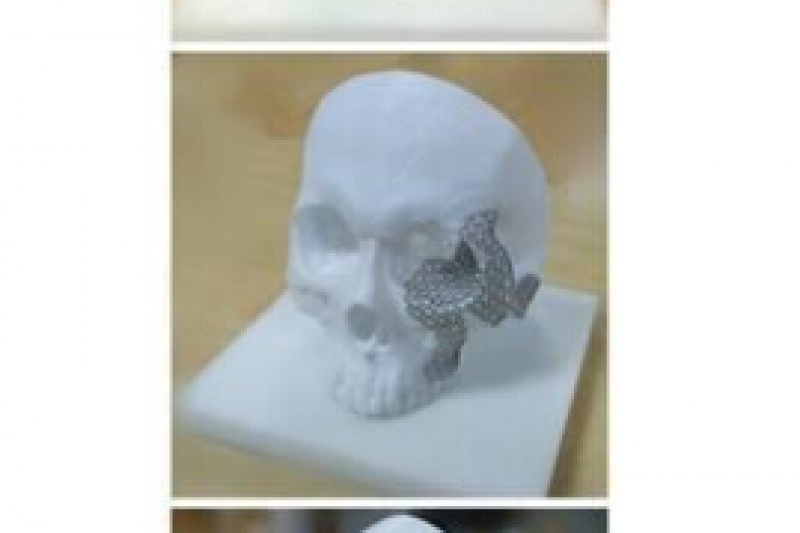 90后云南小伙面部意外粉碎性骨折  3D打印技术“再造”新脸