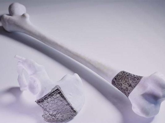 集资六千万！澳大利亚推“即时植入”3D打印项目，肿瘤切除修补骨骼手术二合一