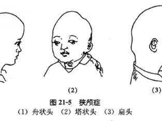 10月大婴儿酷似外星人，3D打印帮助重拼颅骨