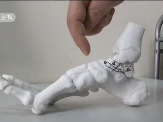 陕西省成功实施3D打印人工距骨假体植入手术