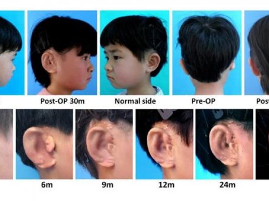 中国科学家利用3D打印技术为小耳症儿童培育新耳朵
