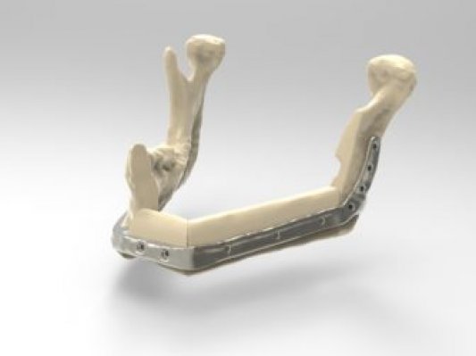 雷尼为口腔癌症患者3D打印下颌骨植入物及手术导板